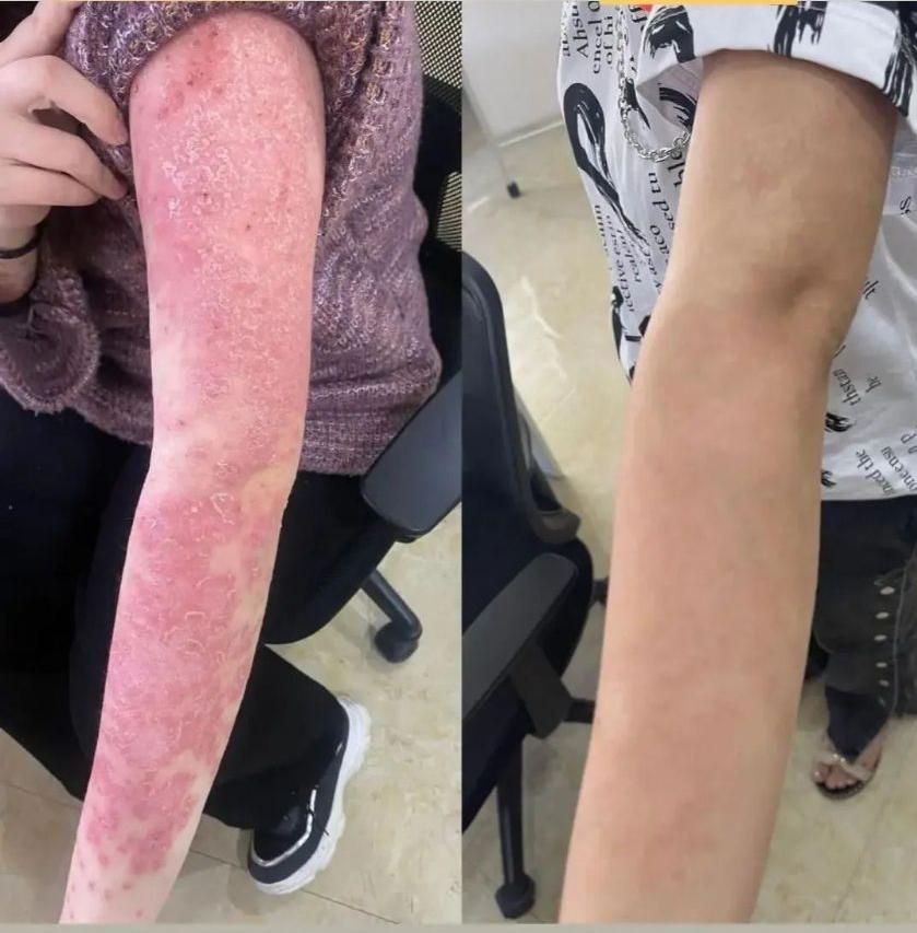 درمان تضمینی پیسی و پسوریازیس|خدمات آرایشگری و زیبایی|مشگین شهر, |دیوار