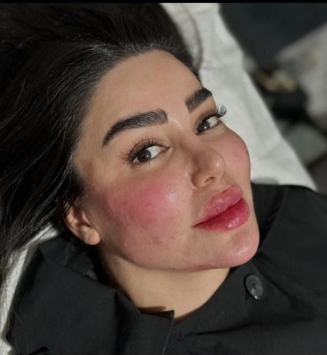 جشنواره ژل بوتاکس.فیلرلیفت نخ.بوتاکس.انزیم.پی ارپی|خدمات آرایشگری و زیبایی|مشهد, سناباد|دیوار