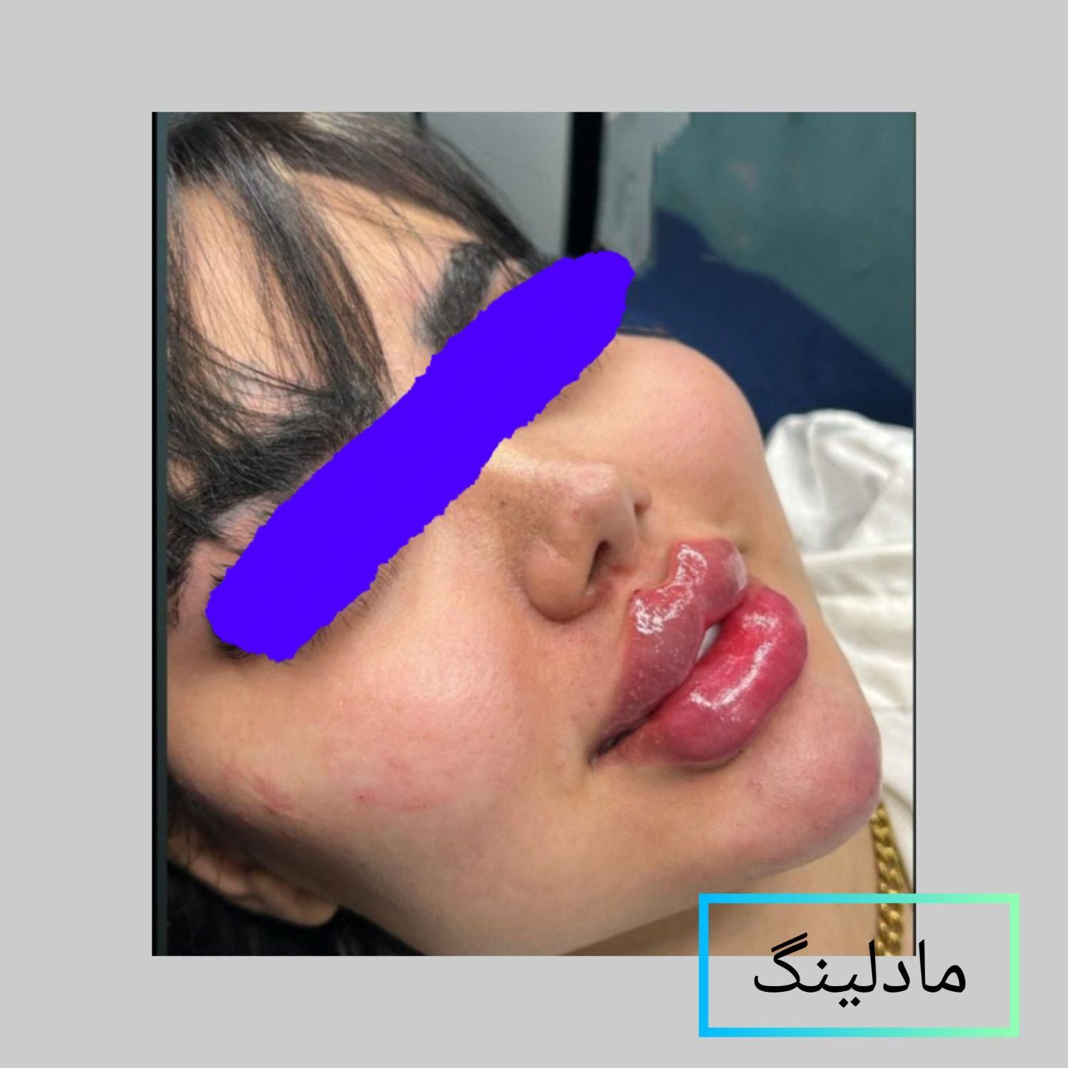 لب روسی پروفیس .جوانسازی.  پزشک|خدمات آرایشگری و زیبایی|اهواز, زیتون کارمندی|دیوار