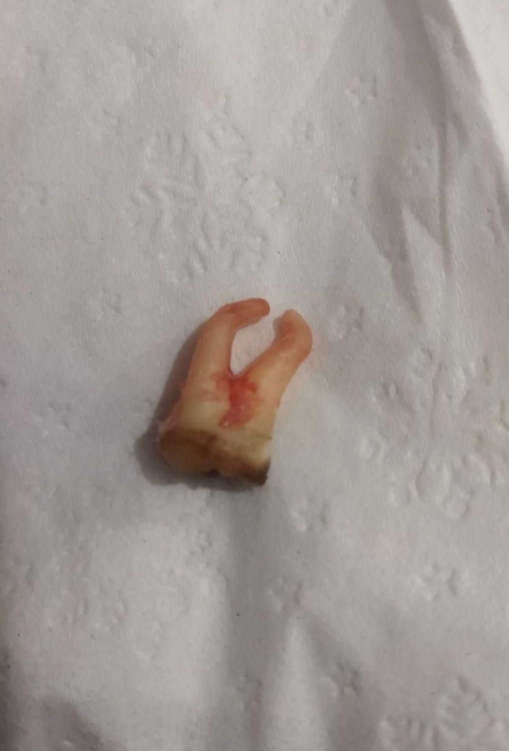 کشیدن دندان های خوی و سلماس|خدمات آرایشگری و زیبایی|خوی, |دیوار