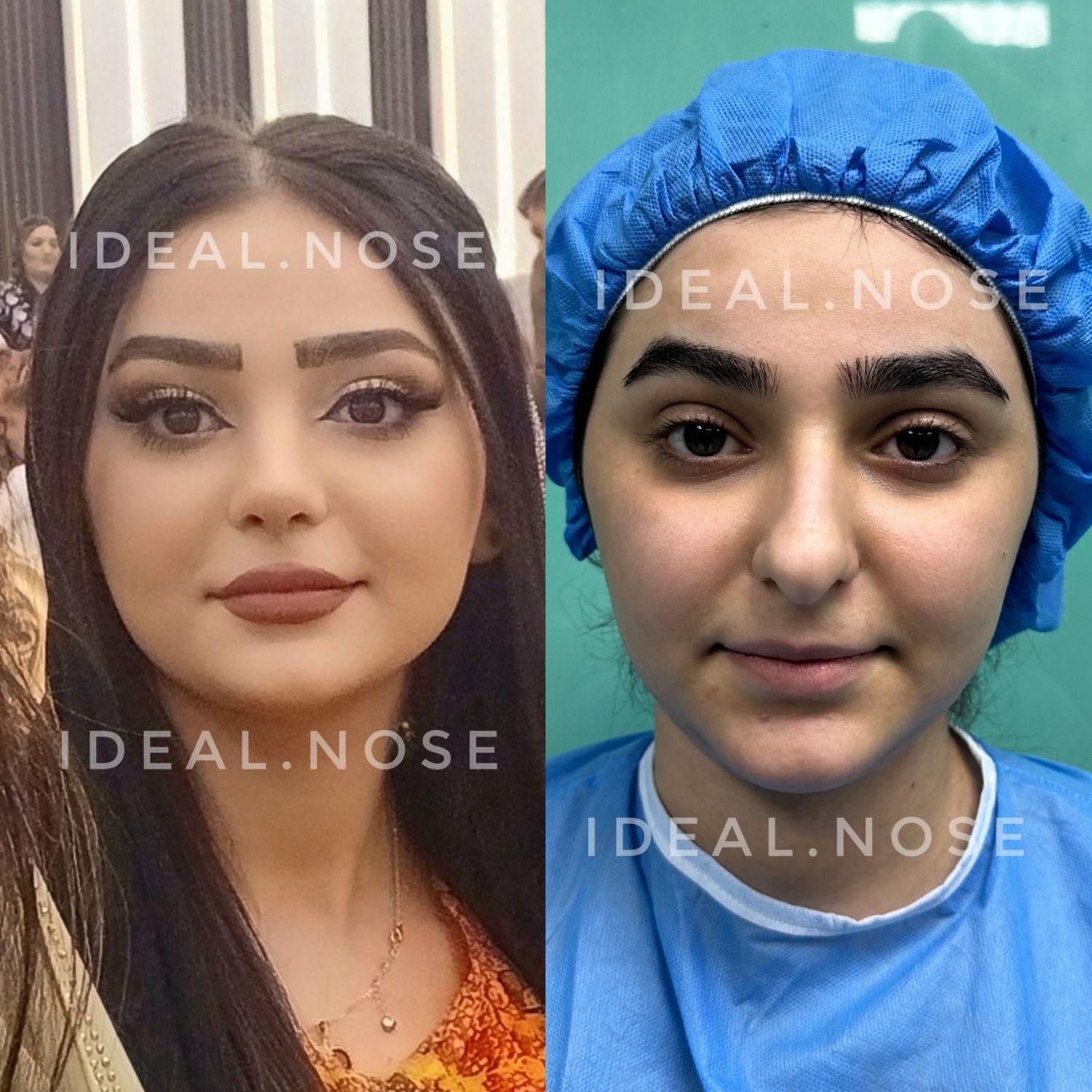 جشنواره عمل زیبایی بینی با تخفیف ویژه|خدمات آرایشگری و زیبایی|سقز, |دیوار