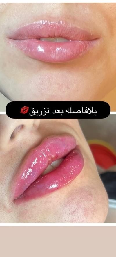 تزریق ژل وبوتاکس آموزش ژل وبوتاکس آنزیم فیلربادی|خدمات آرایشگری و زیبایی|کرمانشاه, |دیوار