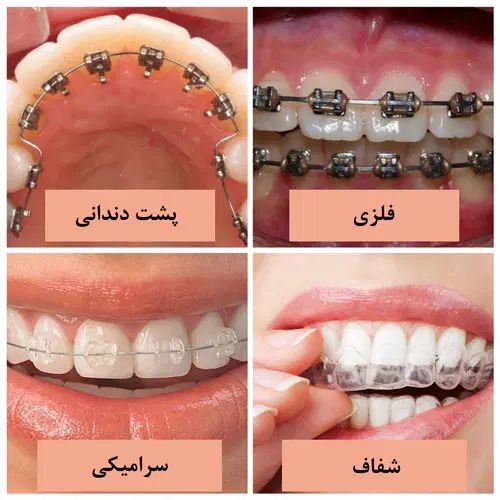 ارتودنسی بدون پیش پرداخت در کلینیک تمام اقساط حامی|خدمات آرایشگری و زیبایی|شیراز, ملاصدرا|دیوار
