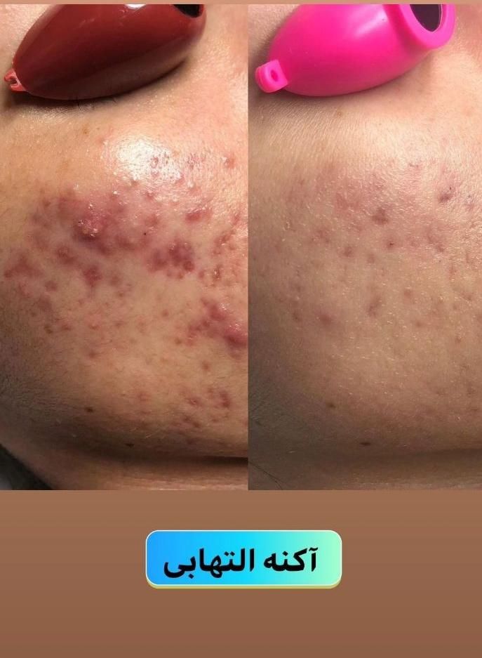 ژل وبوتاکس ولیزر وفشیال وخالبرداری ومزونیدلینگ|خدمات آرایشگری و زیبایی|تبریز, |دیوار