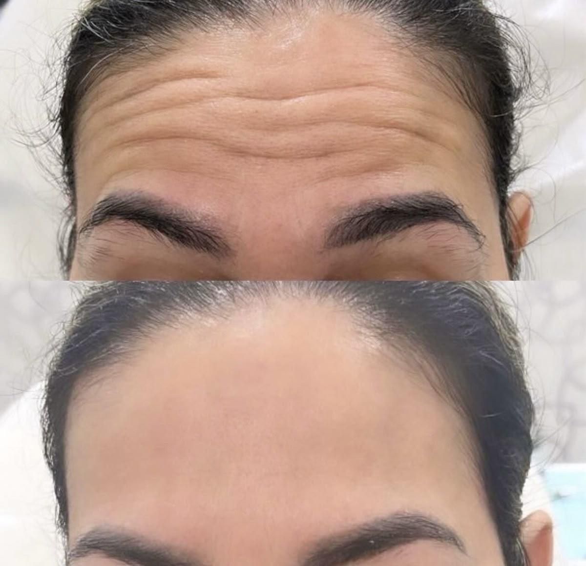 فیلر زیر چشم،ژل ،بوتاکس ،خدمات جوانسازی صورت|خدمات آرایشگری و زیبایی|اندیشه, اندیشه فاز ۱|دیوار
