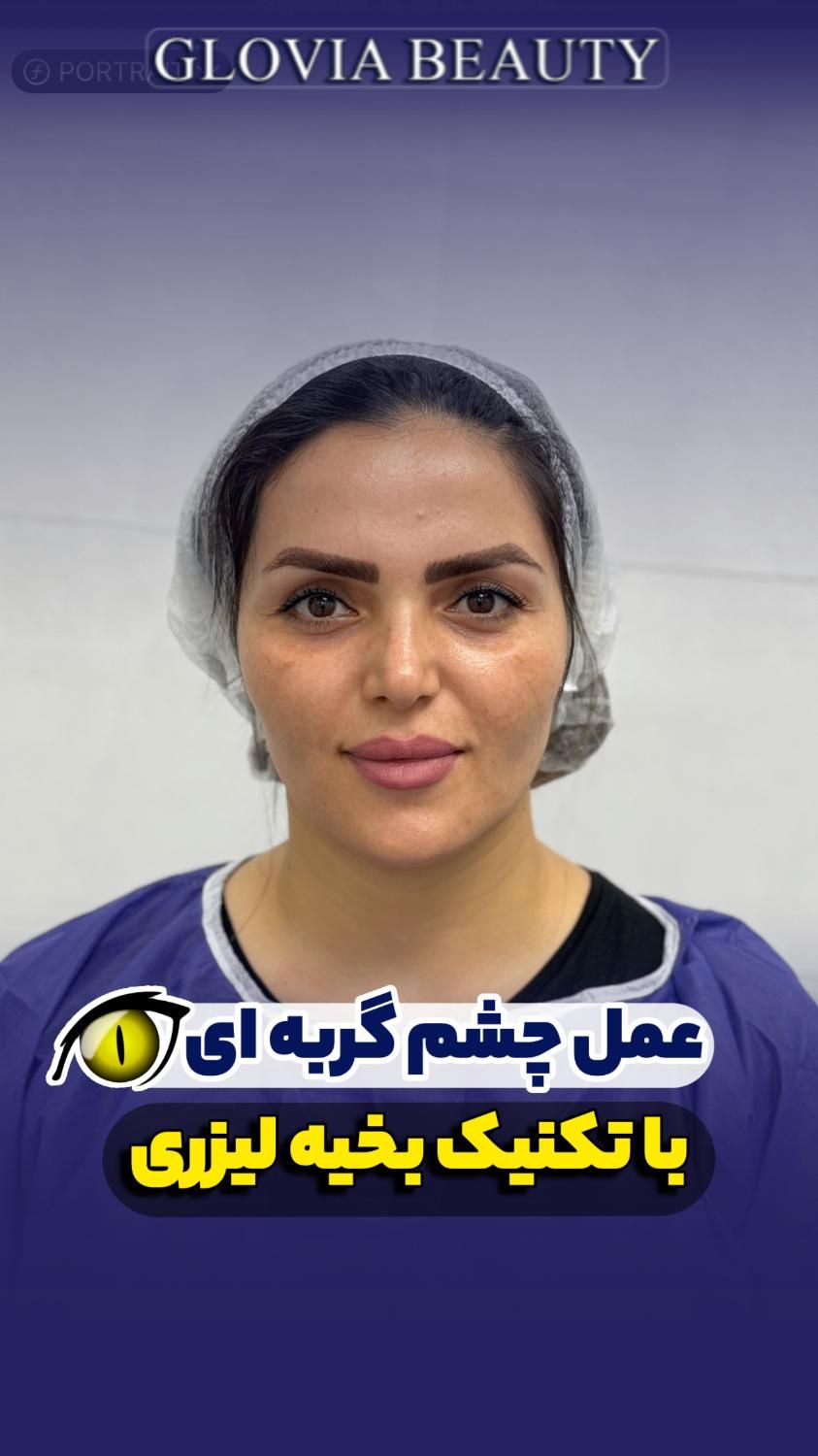 جراحی پلک ،بلفاروپلاستی ،لیفت شقیقه، جراحی زیبایی|خدمات آرایشگری و زیبایی|تهران, امانیه|دیوار