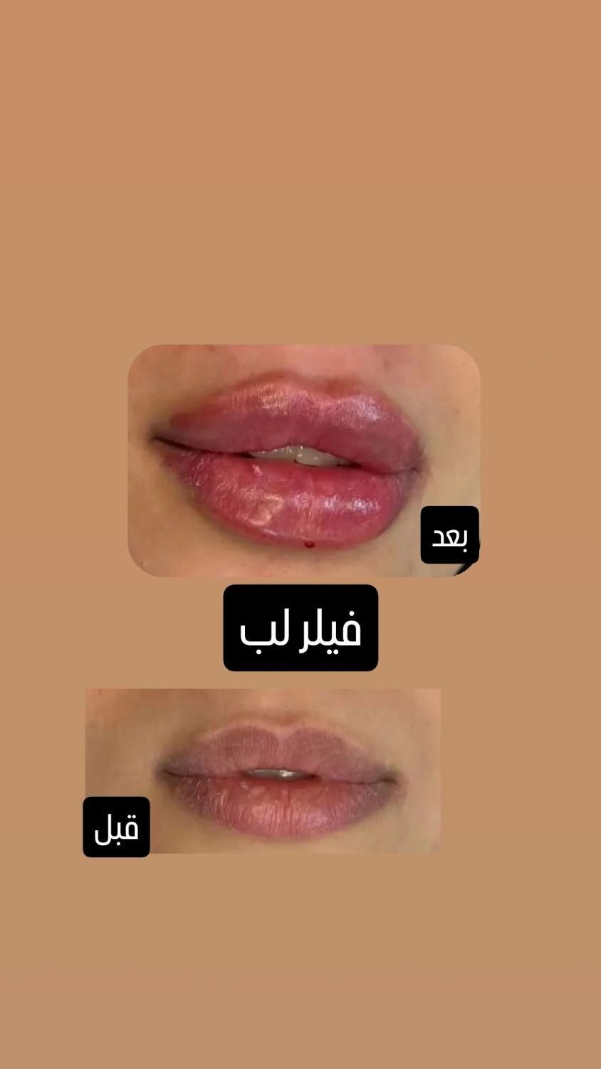 تزریق ژل با قیمت مناسب وبا کیفیت|خدمات آرایشگری و زیبایی|برازجان, |دیوار