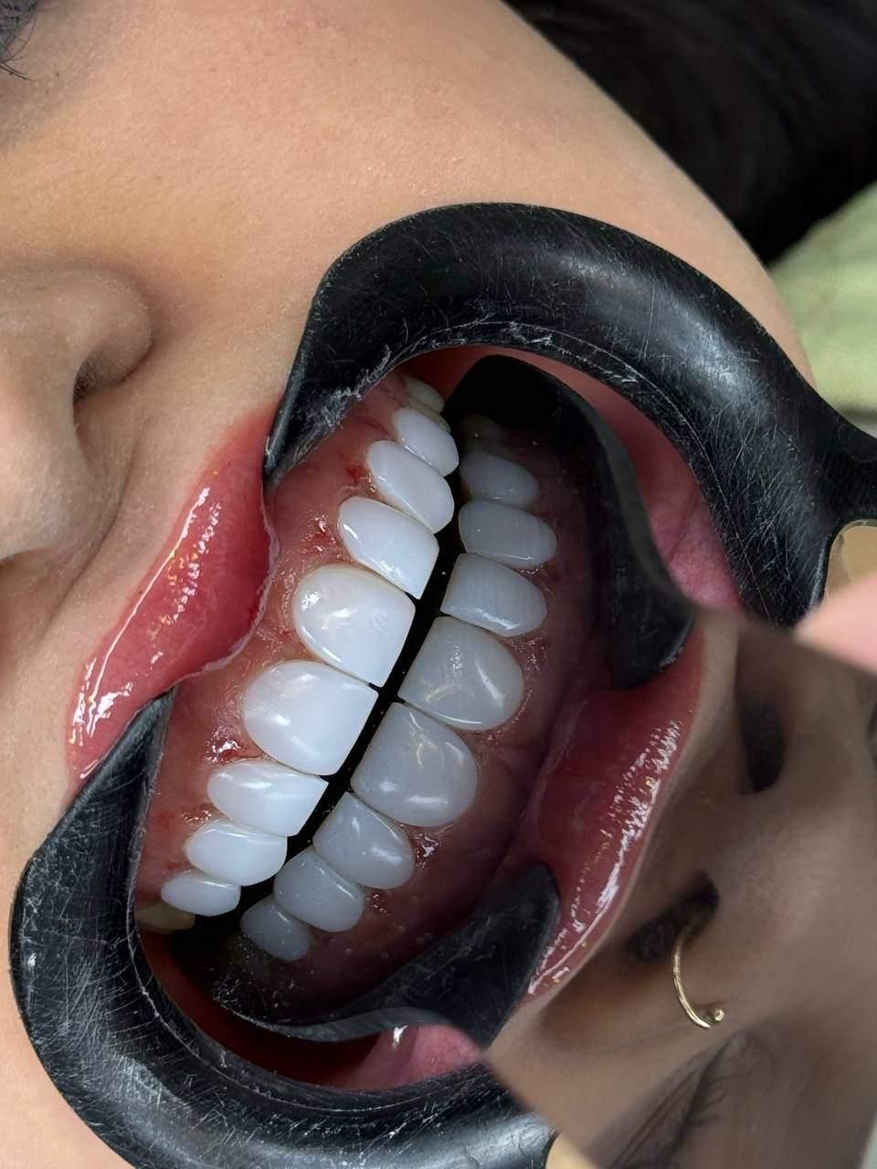 جشنواره کامپوزیت دندان با بهترین متریال آمریکایی|خدمات آرایشگری و زیبایی|آمل, |دیوار