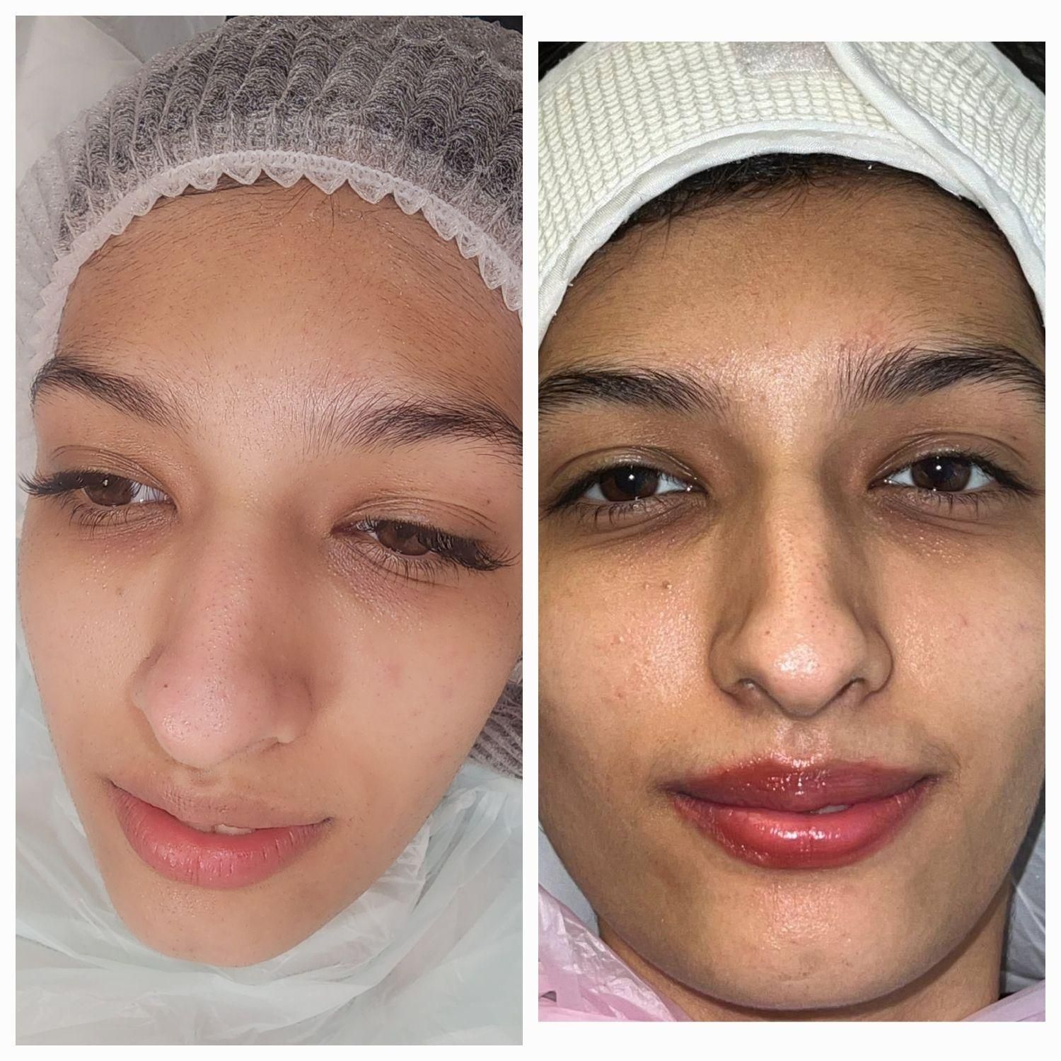 وقت مراقبت از پوستته(پاکسازی،پلاژن تراپی اسیدتراپی|خدمات آرایشگری و زیبایی|بابل, |دیوار