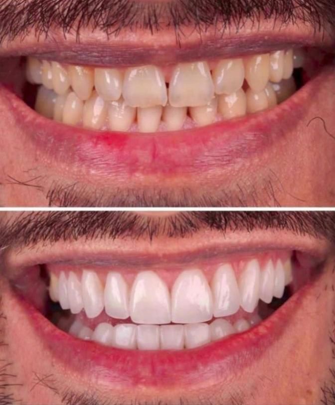 کامپوزیت.لمینت.پروتز.دست دندان|خدمات آرایشگری و زیبایی|تهران, مجیدیه|دیوار
