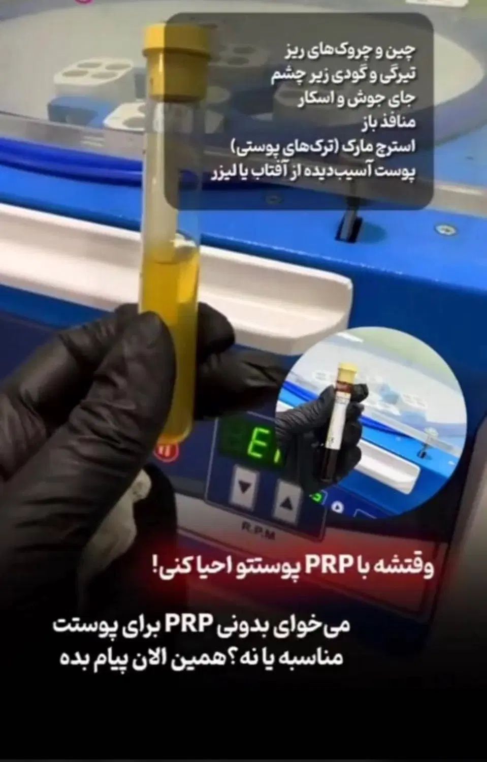 اف تابستانه زیبایی تزریق ژل، بوتاکس، پی ار پی|خدمات آرایشگری و زیبایی|اهواز, کمپلو جنوبی|دیوار
