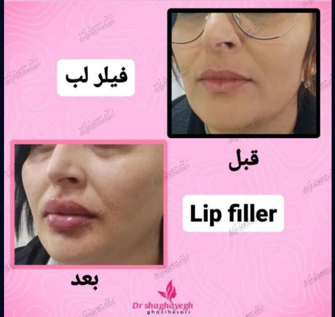 کلینیک لیزربوتاکس مزو دکترعلی حسین‌ زاده پرندبیمه|خدمات آرایشگری و زیبایی|پرند, |دیوار
