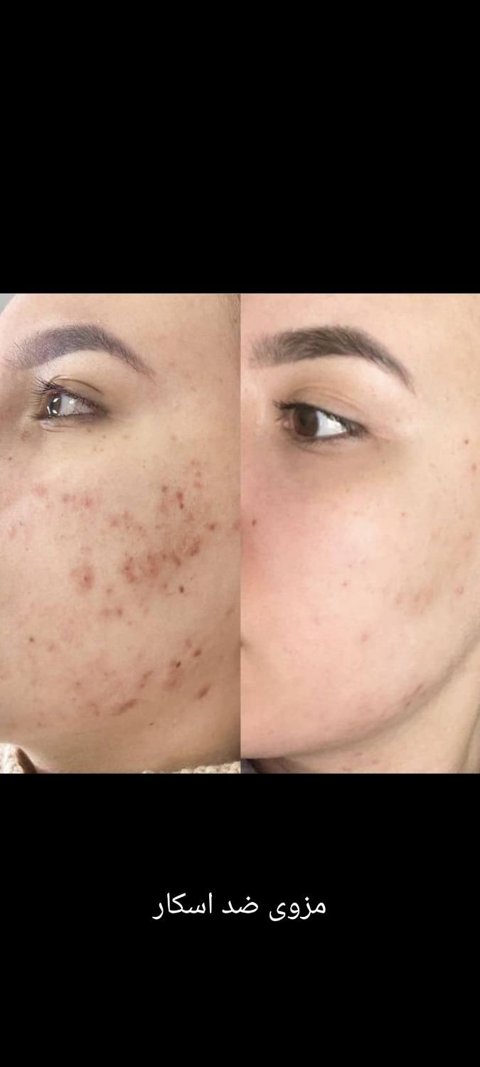 تزریق ژل لب ب روش روسی آنباکسش توسط زیباجو|خدمات آرایشگری و زیبایی|مشهد, پنجتن|دیوار