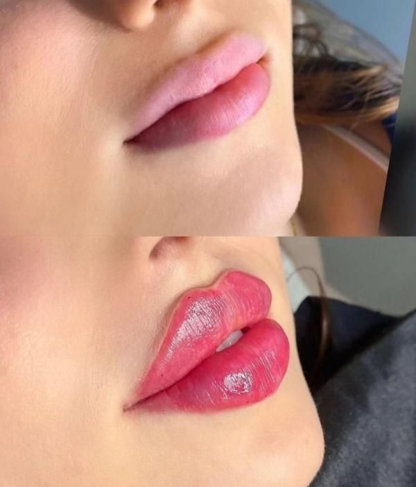 آموزش ژل فیلر لب چانه انزیم چاقی صورت مزو مو فشیال|خدمات آرایشگری و زیبایی|قم, زنبیل آباد|دیوار
