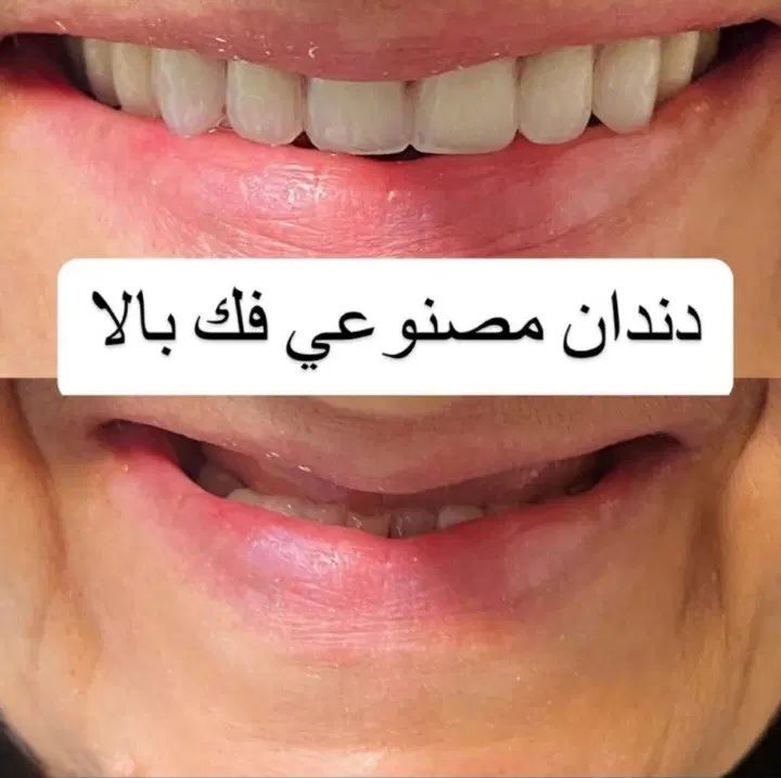دندانساری متحرک(مصنوعی)|خدمات آرایشگری و زیبایی|اصفهان, جاوان|دیوار