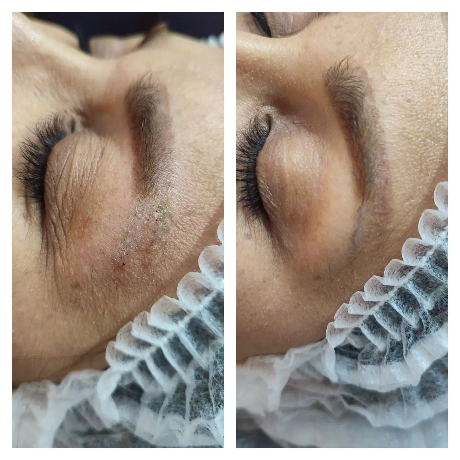 رفع تیرگی بدن حذف تتو صورت و بدن. کربن تراپی|خدمات آرایشگری و زیبایی|تربت‌حیدریه, کاشانی|دیوار