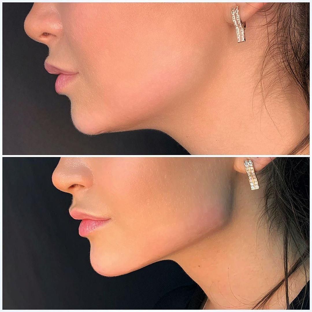 فیلر بادی/کانتورینگ صورت/تزریق چربی/بوتاکس/ژل لب|خدمات آرایشگری و زیبایی|تهران, تهرانپارس غربی|دیوار