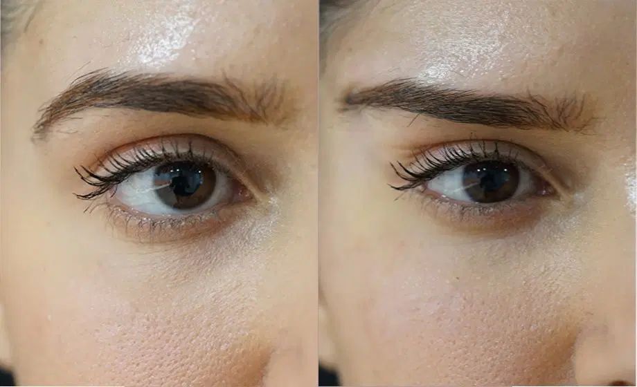 مدل لیفت صورت و ابرو با نخ توسط پزشک در کلینیک|خدمات آرایشگری و زیبایی|تهران, علم و صنعت|دیوار