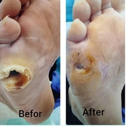 تزریقات سرم سوند پانسمان زخم بستر پای دیابتی|خدمات آرایشگری و زیبایی|تبریز, |دیوار