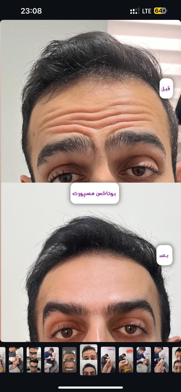 تزریق ژل بوتاکس لیزر فیلر فیشال پاک کردن تاتو|خدمات آرایشگری و زیبایی|قدس, شهر‌قدس|دیوار