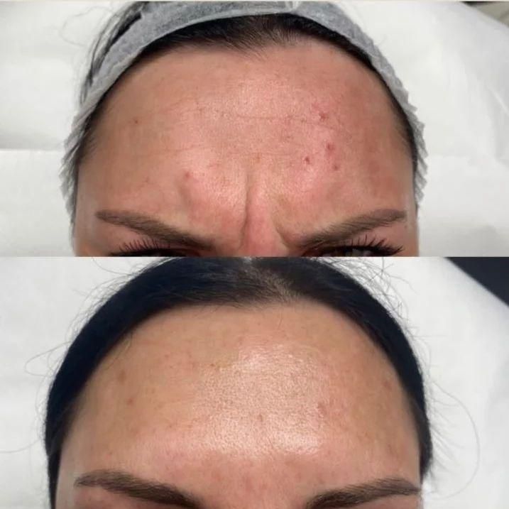 اموزش. بوتاکس فول فیس چشم گربه ای لیفت شقیقه|خدمات آرایشگری و زیبایی|خرم‌آباد, |دیوار