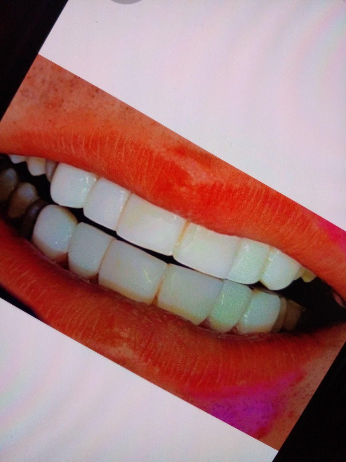 دندانسازی کامپوزیت،لمینیت(قیمت توتوضیحات)ژل بوتاکس|خدمات آرایشگری و زیبایی|ارومیه, |دیوار