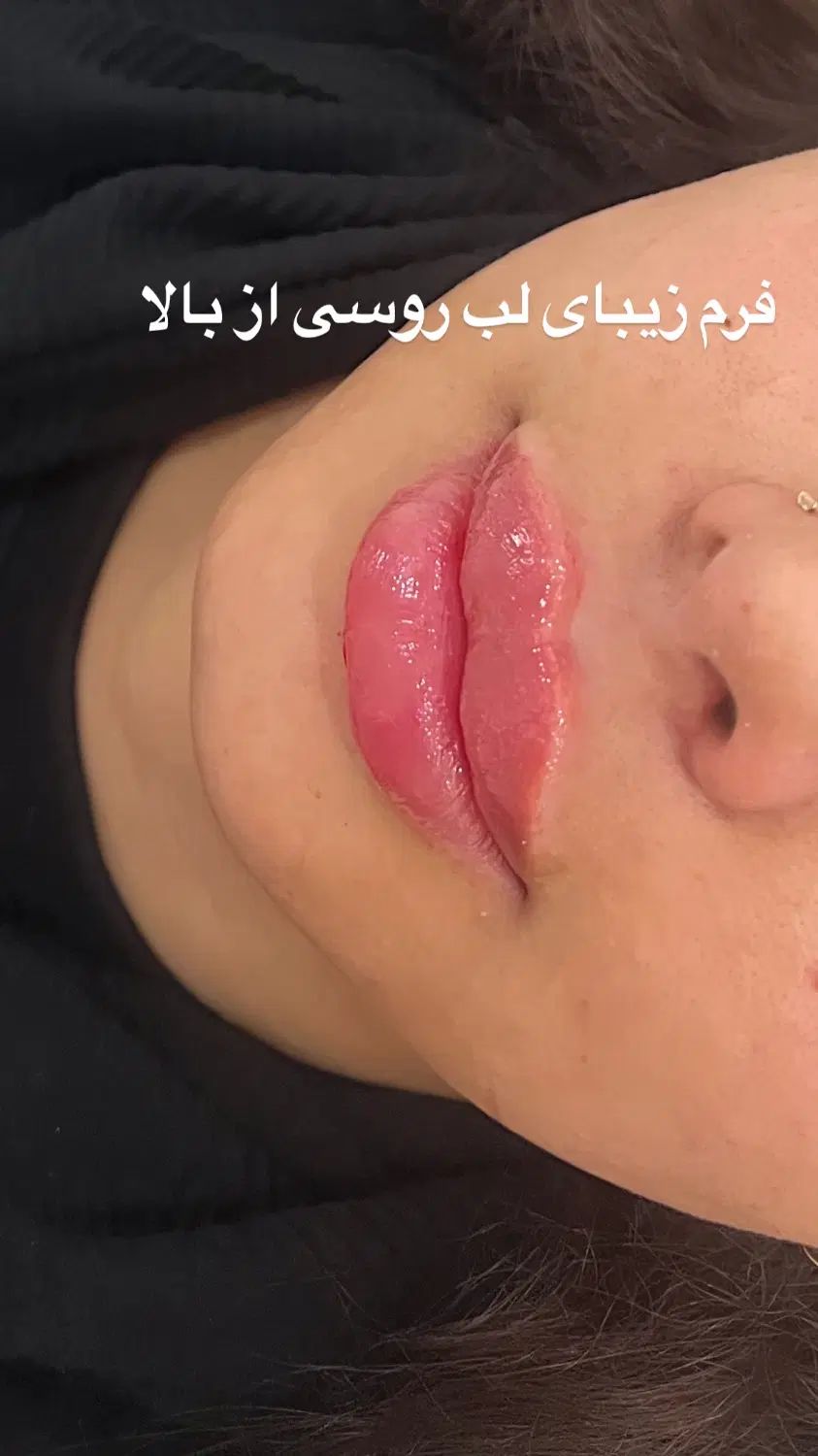 تزریق ژل لب روسی با متد تخصصی روسی و بوتاکس|خدمات آرایشگری و زیبایی|رشت, گلسار|دیوار