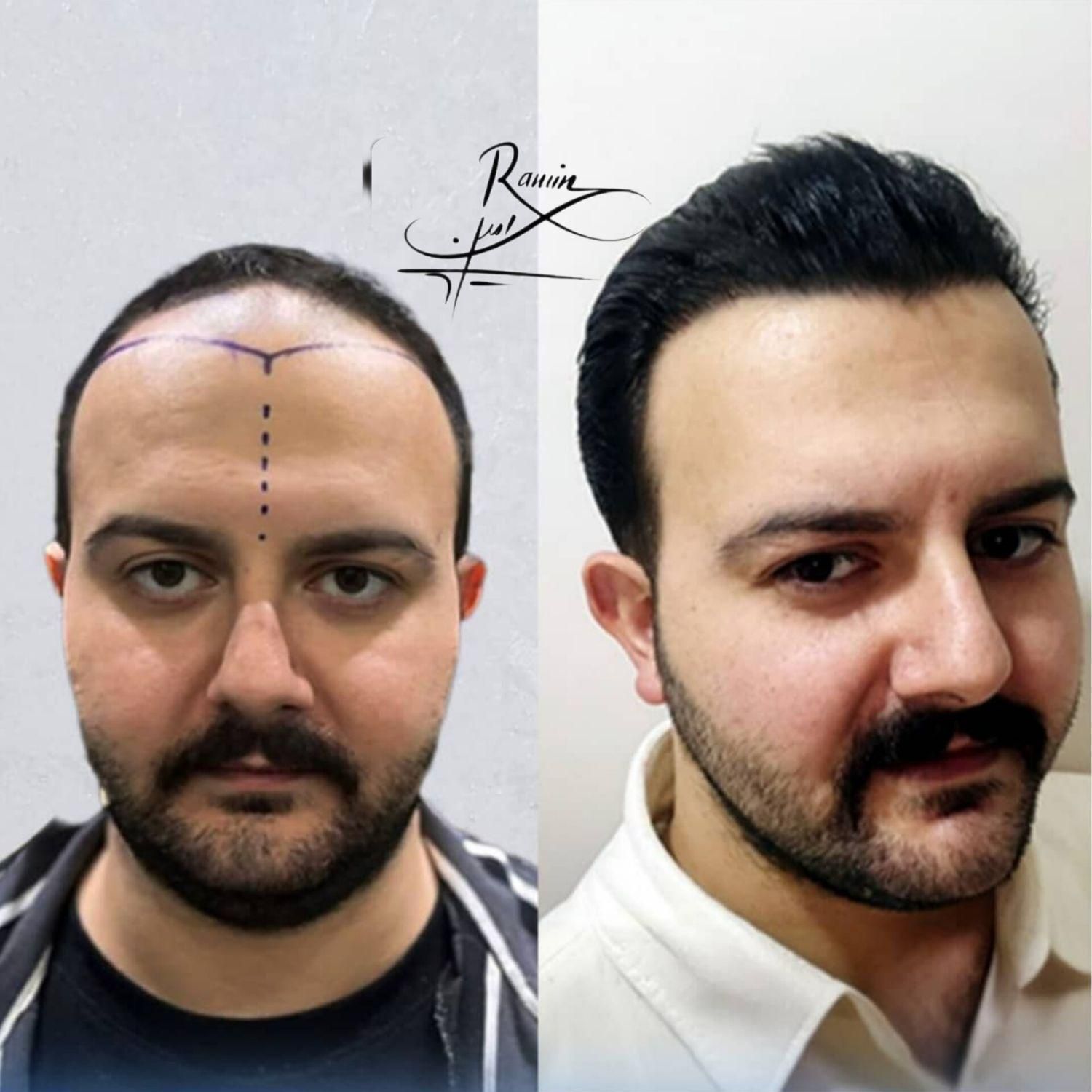کاشتمو سوپرترکیبی تحت نظر پزشک متخصص|خدمات آرایشگری و زیبایی|سنندج, |دیوار