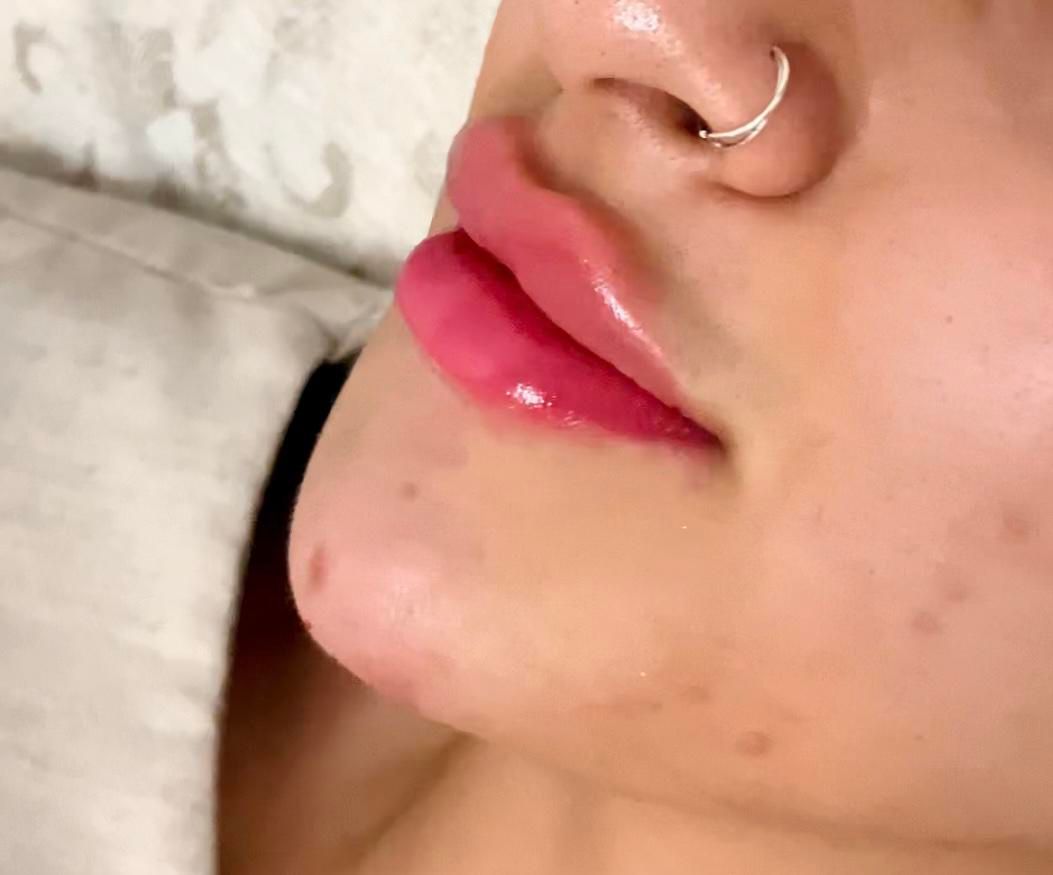 تزریق ژل و بوتاکس،فیلر بدن و لیفت با نخ|خدمات آرایشگری و زیبایی|کیش, |دیوار