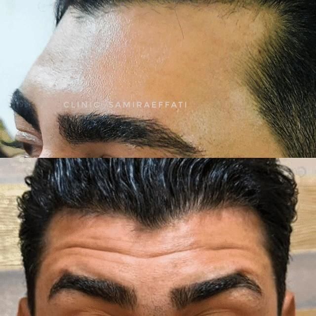 ژل و بوتاکس با قیمت باورنکردنی ظرفیت محدود|خدمات آرایشگری و زیبایی|کاشان, درب اصفهان|دیوار