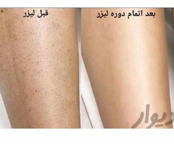 لیزر موهای زائد در ۳جلسه|خدمات آرایشگری و زیبایی|اصفهان, وحید|دیوار