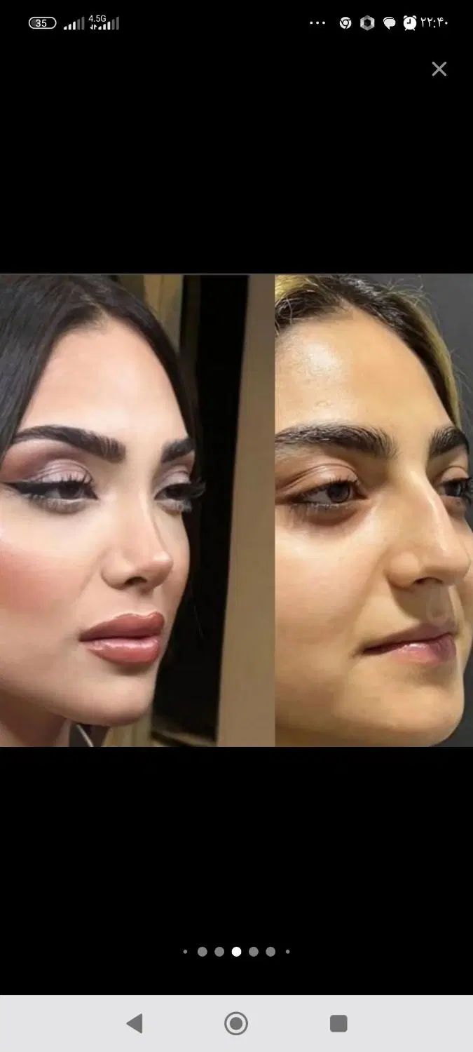 عمل بینی ابدو ساکشن اسلیو لیفت شقیقه وام|خدمات آرایشگری و زیبایی|آمل, |دیوار