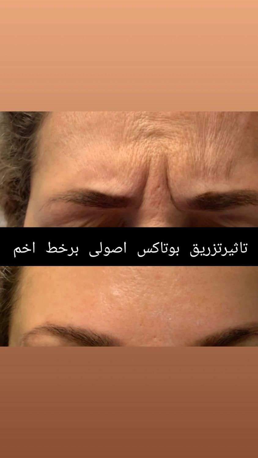 تزریق تخصصی ژل و بوتاکس رشت|خدمات آرایشگری و زیبایی|رشت, بلوار گیلان|دیوار