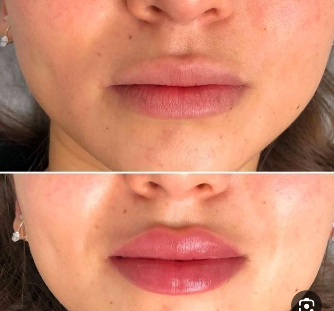 بوتاکس صورت ۸۰۰ تومان ژل لب گونه۹۵۰تخفیف ویژه|خدمات آرایشگری و زیبایی|بابل, |دیوار
