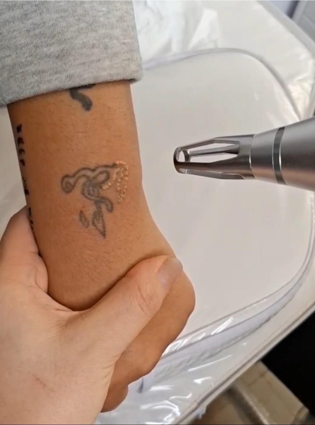 پاک کردن تاتو بدون درد با دستگاه کیوسوئیچ پیکوسکند|خدمات آرایشگری و زیبایی|ساری, |دیوار