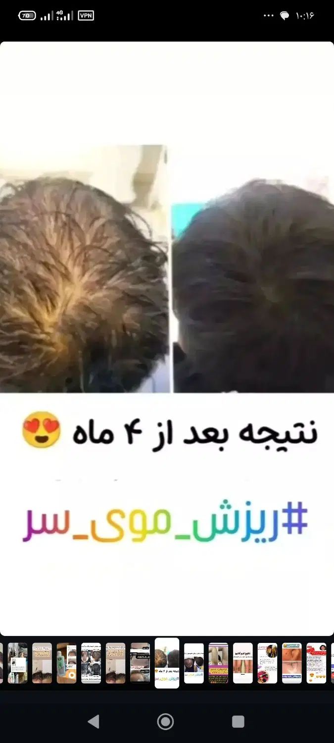 پک ریزش و رویش مجدد مو|آرایشی، بهداشتی، درمانی|تهران, فلاح|دیوار