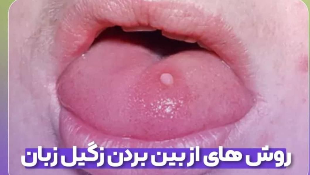 درمان فوری زگیل دهانی و تناسلی توسط پزشک پوست|خدمات آرایشگری و زیبایی|مشهد, آزادشهر|دیوار