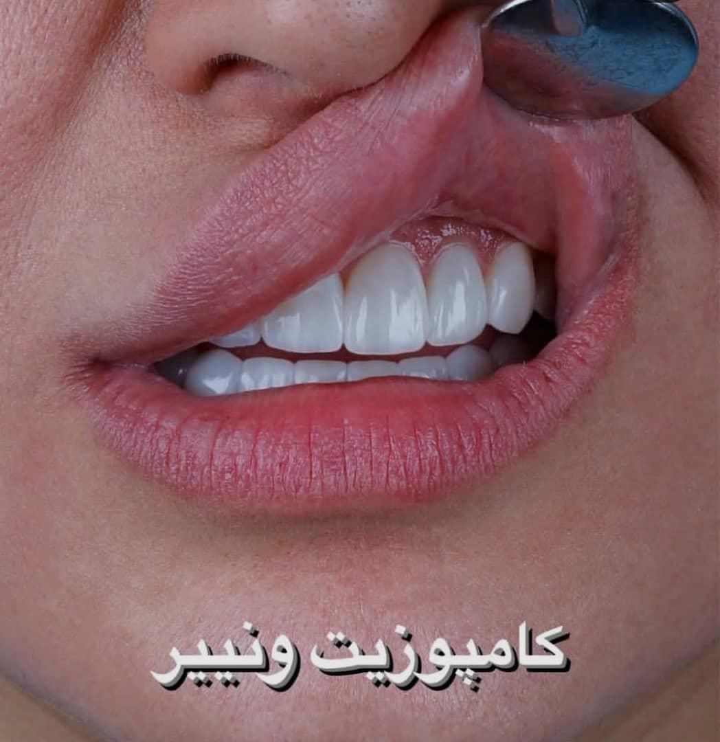 کامپوزیت ونیر لمینیت  عصب کشی ترمیم روکش ایمپلنت|خدمات آرایشگری و زیبایی|تهران, تهرانپارس شرقی|دیوار