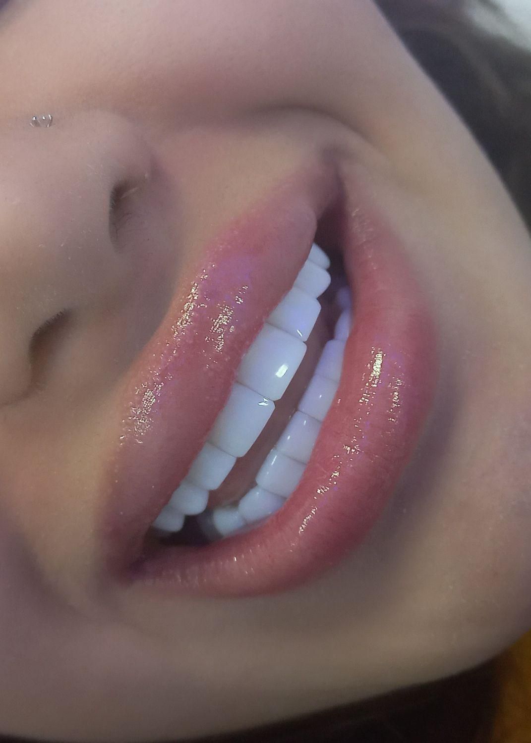 کامپوزیت دندان (( طرح لبخند ))|خدمات آرایشگری و زیبایی|یاسوج, |دیوار