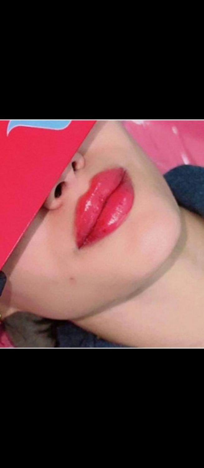 بوتاکس فیلر پی آر پی مزوتراپی زگیل تناسلی|خدمات آرایشگری و زیبایی|تبریز, |دیوار