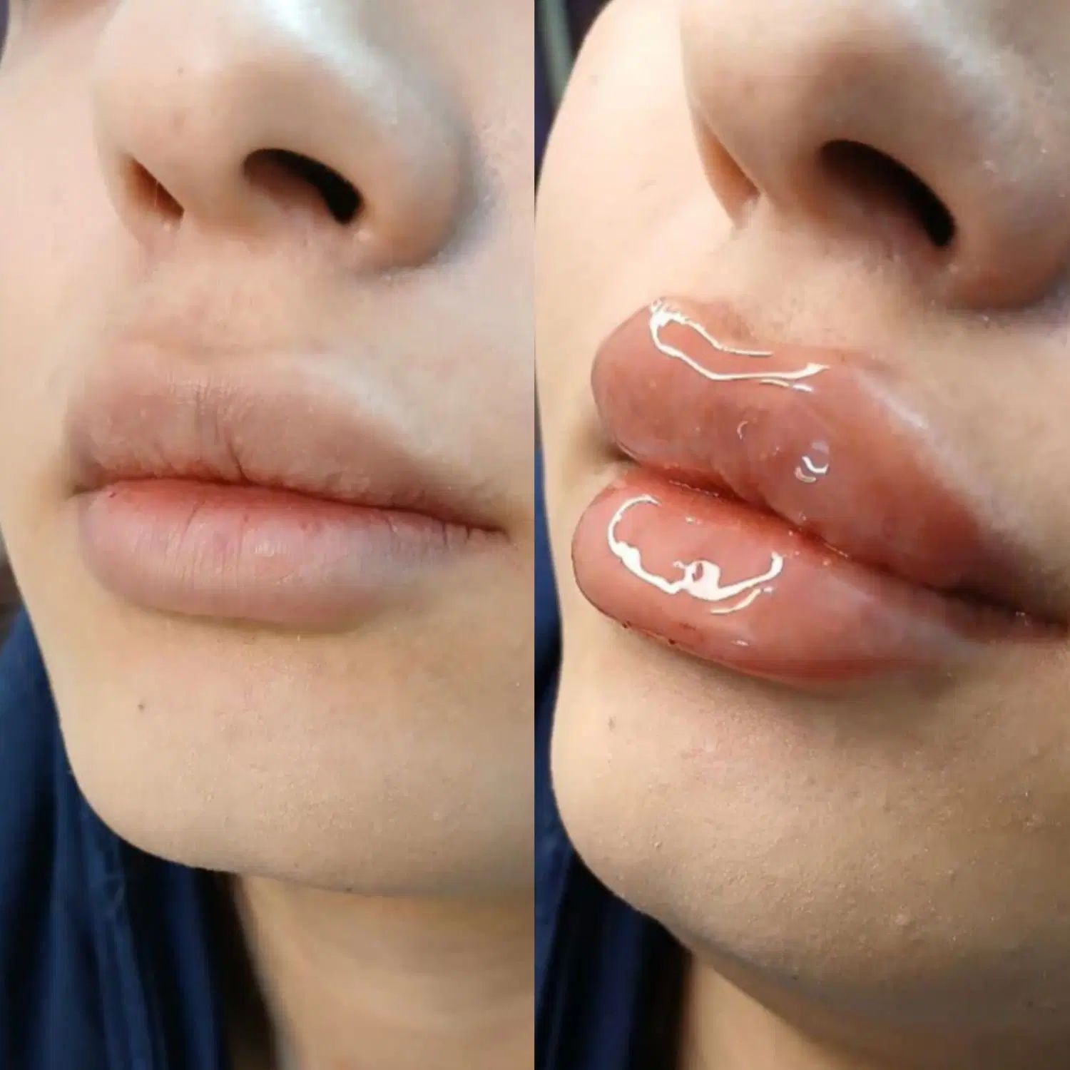 تزریق ژل فیلر بوتاکس مزوتراپی مزوژل لیزر فیشیال|خدمات آرایشگری و زیبایی|کرج, گوهردشت|دیوار