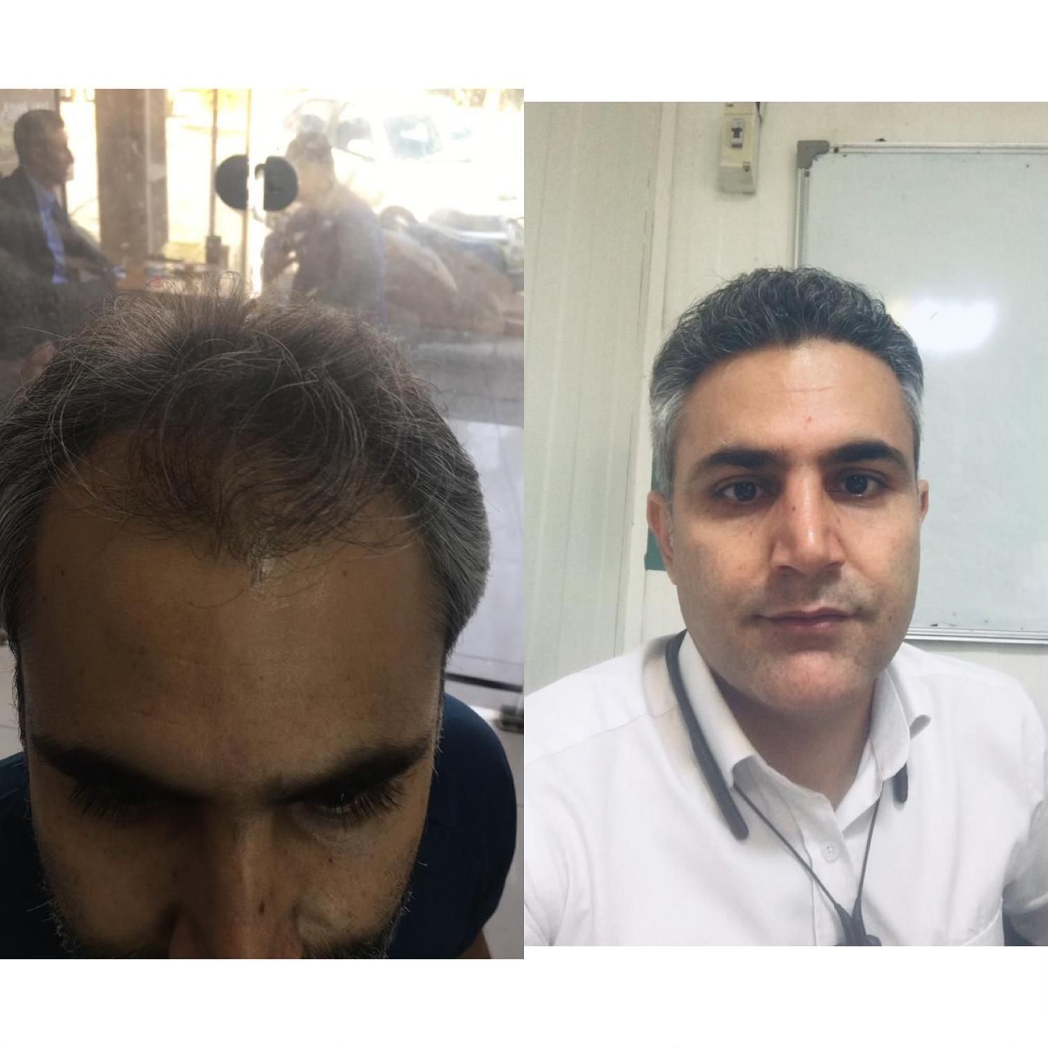 کاشت مو/ابرو /ریش|خدمات آرایشگری و زیبایی|شیراز, قدوسی غربی|دیوار