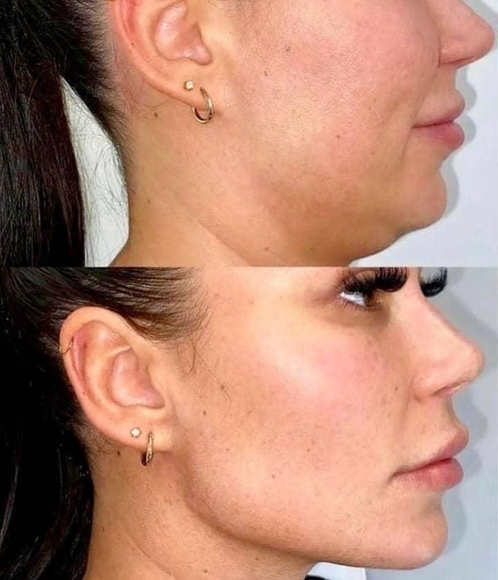 مدل برای هایفوتراپی فقط باقیمت استثنایی 950تومان|خدمات آرایشگری و زیبایی|تبریز, |دیوار