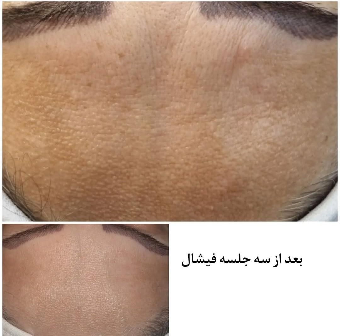 تخفیف خدمات فیشال و پاکسازی پوست مرکز زیبایی دانژه|خدمات آرایشگری و زیبایی|شوشتر, |دیوار