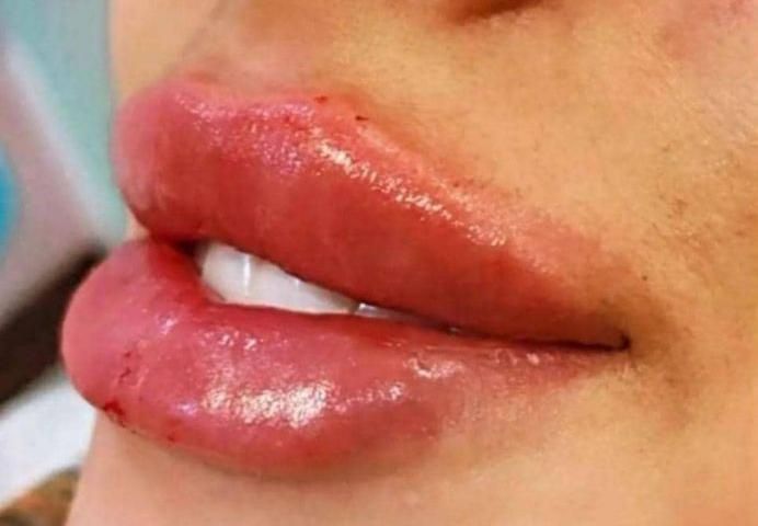 ژل بوتاکس جربی آنزیم مزو پی آرپی مامایی کاشت مو|خدمات آرایشگری و زیبایی|اهواز, نادری|دیوار