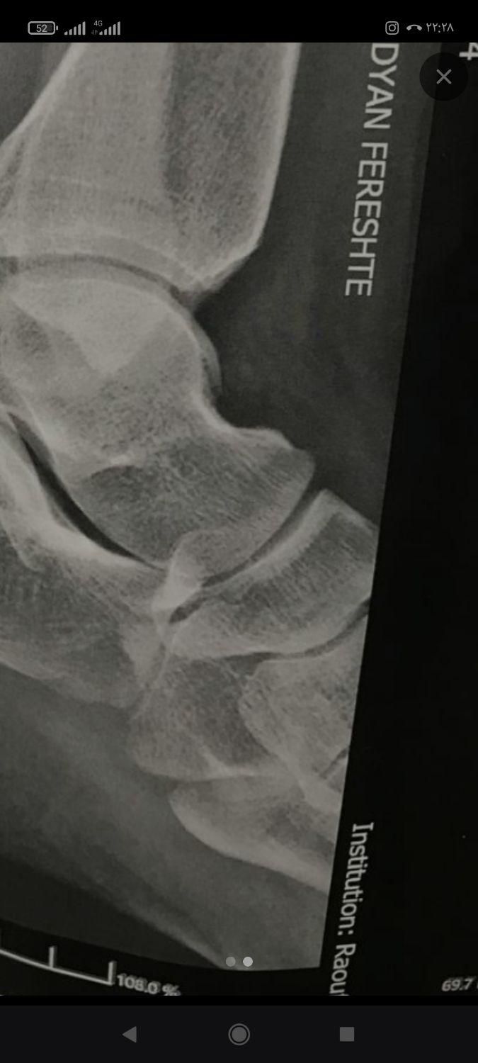 شکسته بندی در کرج و فردیس سیار منزل|خدمات آرایشگری و زیبایی|مشکین‌دشت, |دیوار