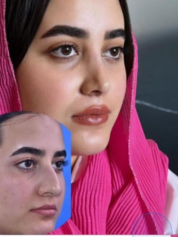 جشنواره عمل زیبایی بینی توسط متخصص نوبت فوری|خدمات آرایشگری و زیبایی|اهواز, کیانپارس |دیوار