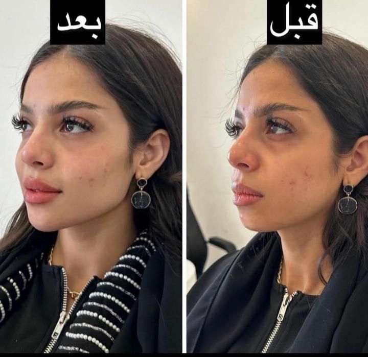تزریقات ژل بوتاکس..  کاشت ابرو .ومو|خدمات آرایشگری و زیبایی|اسلام‌شهر, باغ فیض|دیوار