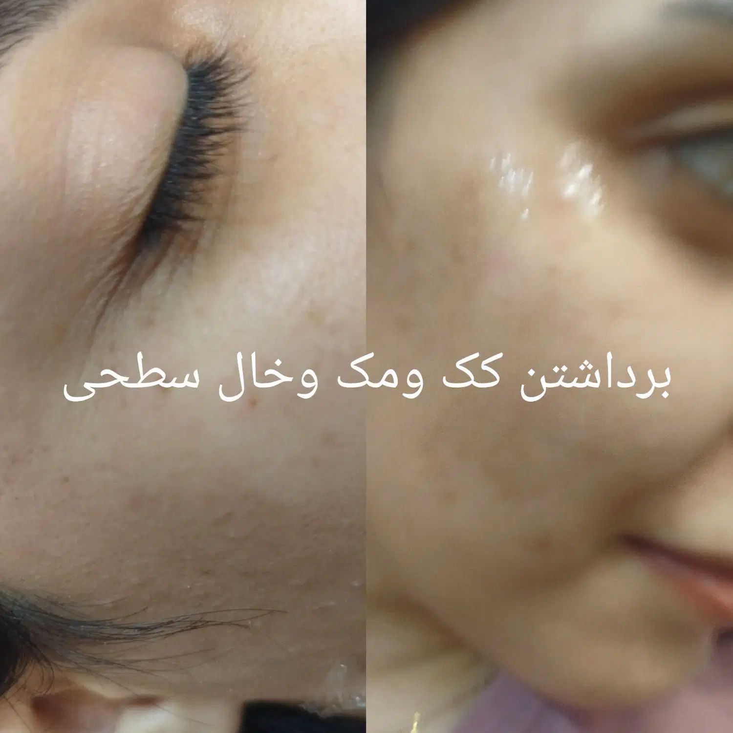 پلکسر وخال برداری ، مزونیدلینگ ، فشیال تخصصی|خدمات آرایشگری و زیبایی|مشهد, طلاب|دیوار