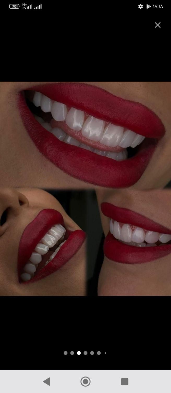 کامپوزیت دندان لیانا همراه با شرایط|خدمات آرایشگری و زیبایی|تهران, نارمک جنوبی|دیوار